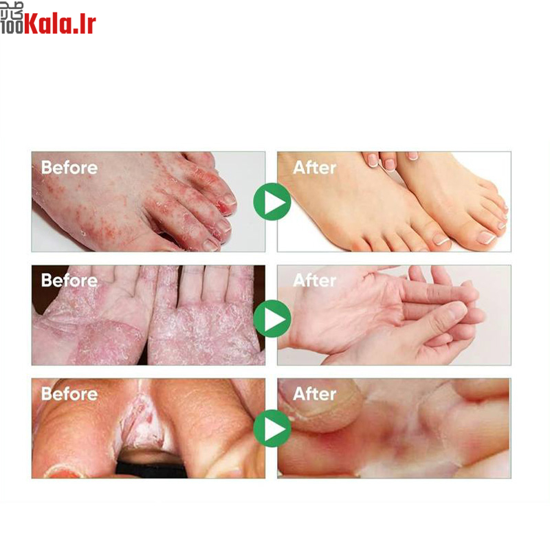 اسپری گیاهی ضد بو و درمان زخم پا حجم 30 میلی لیتر 6 اسپری گیاهی ضد بو و درمان زخم پا حجم 30 میلی لیتر - Image 6