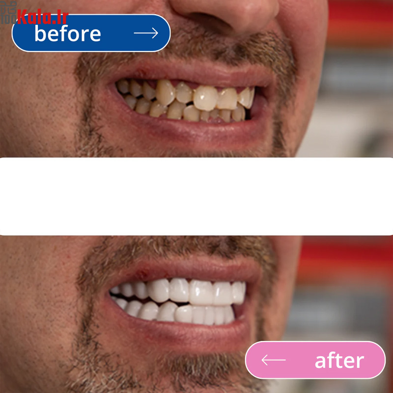 لمینت دندان دو فک مدل TruSmile به همراه نوار چسب سفید کننده دندان 2 لمینت دندان دو فک مدل TruSmile به همراه نوار چسب سفید کننده دندان - Image 2