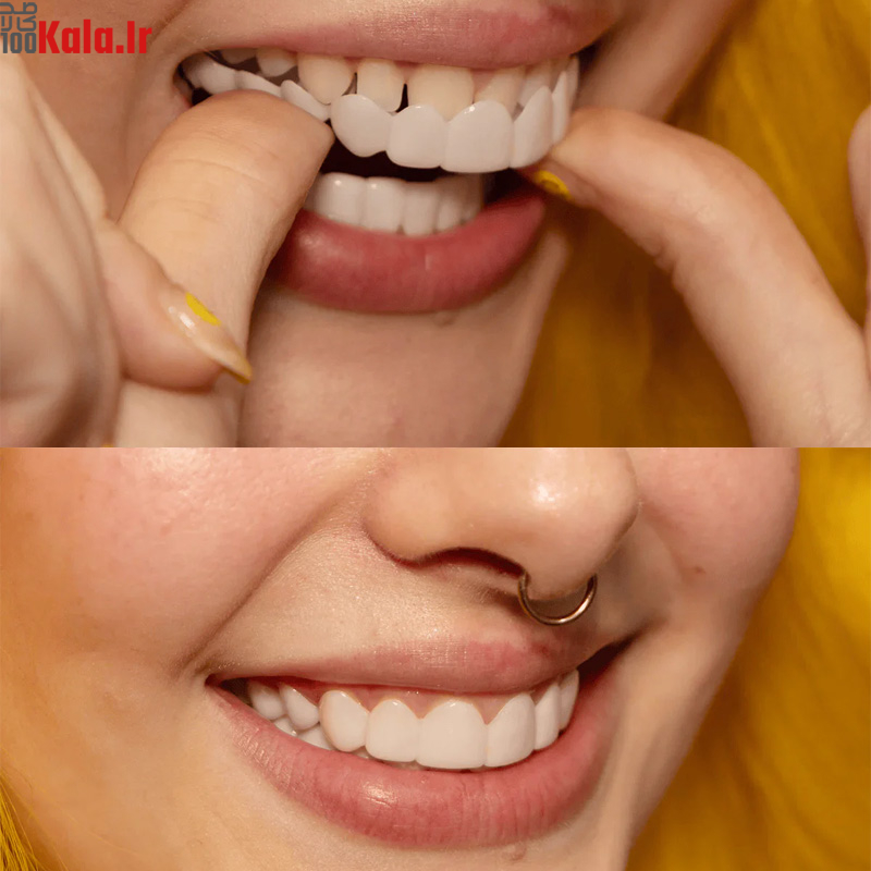 لمینت دندان دو فک مدل TruSmile به همراه نوار چسب سفید کننده دندان 5 لمینت دندان دو فک مدل TruSmile به همراه نوار چسب سفید کننده دندان - Image 5