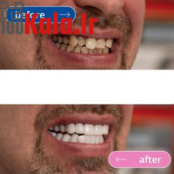 لمینت دندان دو فک مدل TruSmile به همراه نوار چسب سفید کننده دندان 7 لمینت دندان دو فک مدل TruSmile به همراه نوار چسب سفید کننده دندان - Image 7